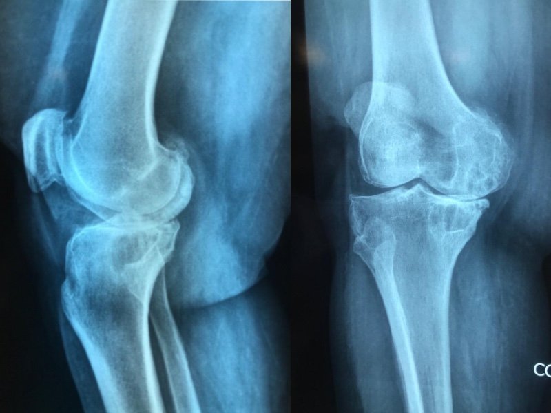 Osteoartritis de rodilla